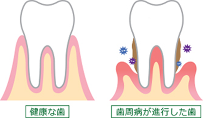 歯周病とは？