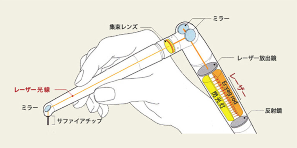 ライトタッチレーザーはあらゆる口腔治療が可能な歯科レーザーです