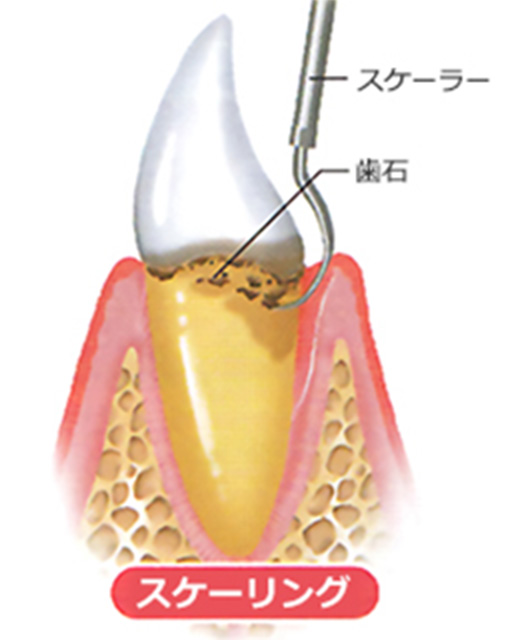 専門家による定期的ケア【リコール】
